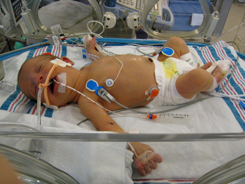 stevie-NICU-CHD-OHS-01